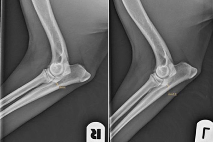 Röntgen: die vermehrte Skleorisierung der Elle