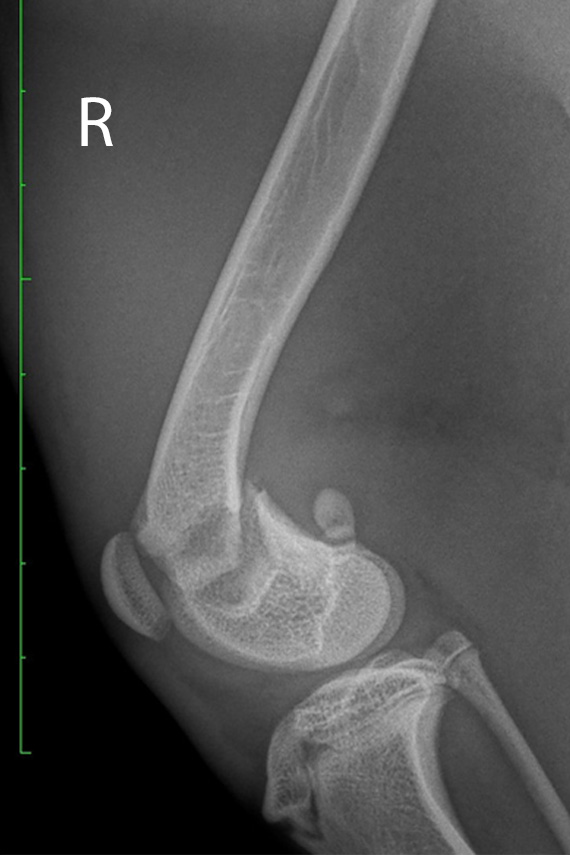 Salter Harris Fraktur