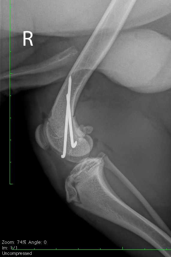 Versorgung der Fraktur mit Pins