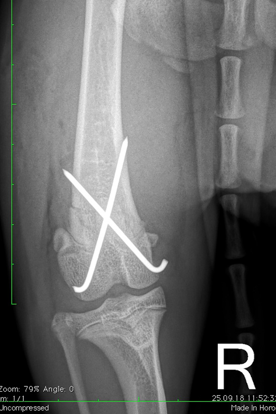 Salter Harris Fraktur post-operativ