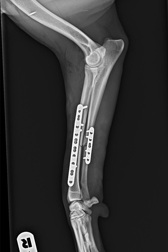 Versorgung Radius Ulna Fraktur