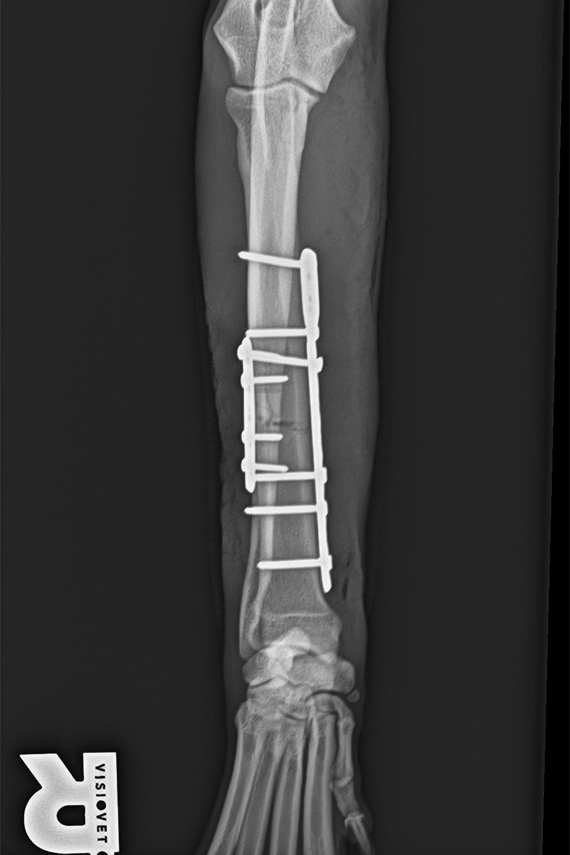 Ulna Fixateur post-op