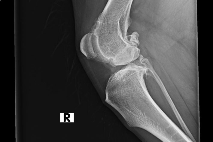 Röntgenbild Hochgradige Kniegelenksarthrose