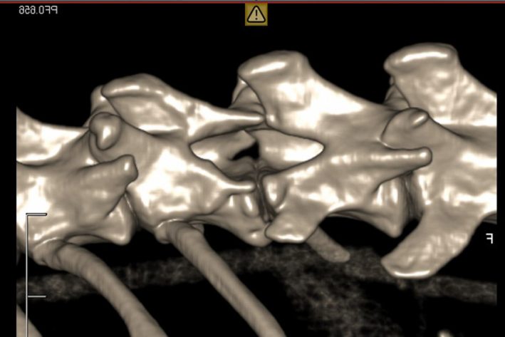 CT 3D-Rektonstruktion nach Laminektomie und Entfernung des Rückenmarkstumors