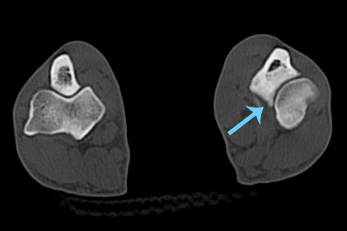 CT Fissur Am Proc. Coronoideus