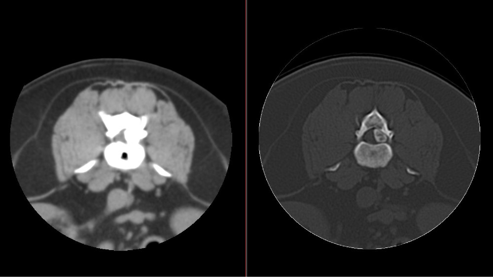 CT Bandscheibenvorfall Lendenwirbelsäule postoperativ