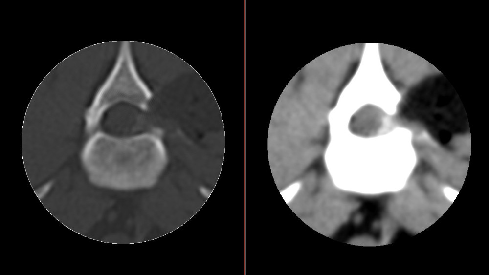 CT rechtsseitiger Bandscheibenvorfall Lendenwirbelsäule