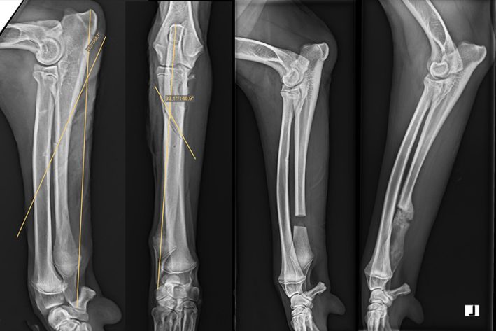 Distale Ulnaostektomie