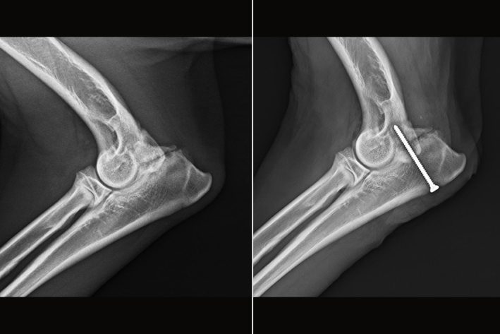 Isolierter Processus Anconeus vor (Abb. links) und nach (Abb. rechts) dem Anschrauben.