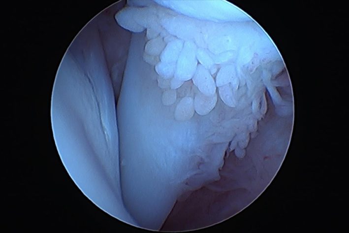 Arthoskopisches Bild einer gesunden Bizepssehne