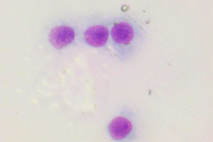 Zytologische Untersuchung eines Hautknotens