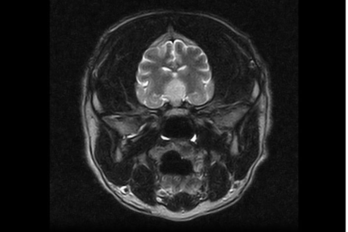 Hyperadrenokortizismus MRT
