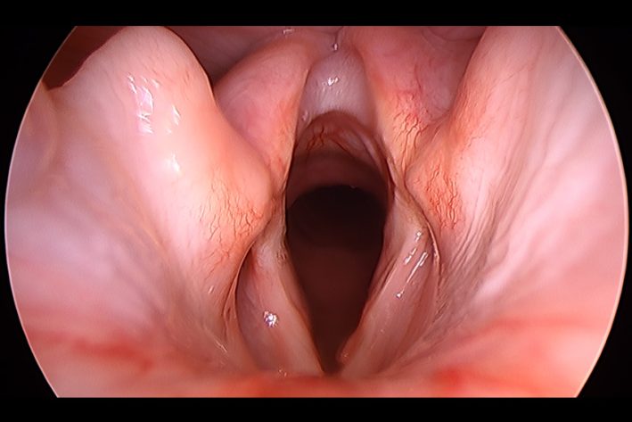 Durch eine Operation kann die Stimmritze einseitig weiter geöffnet werden