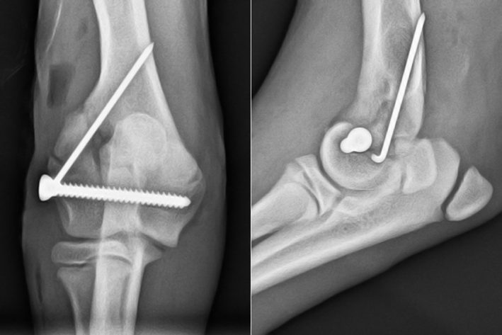 Ellenbogen nach der Operation – Versorgung mit einer Schraube und Pin