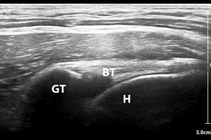 Kontralaterale, gesunde Bizepssehne