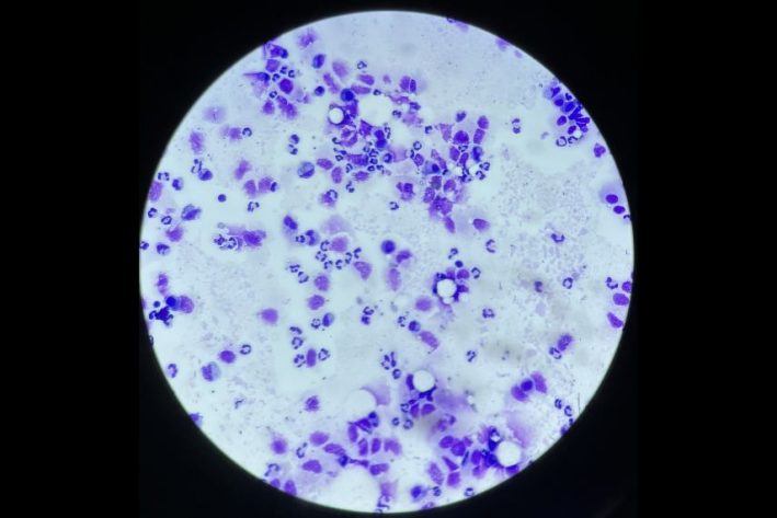 Liquidothorax Zytologie