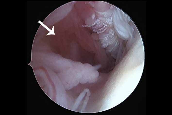 luxierte Bizepssehne mit Teilruptur