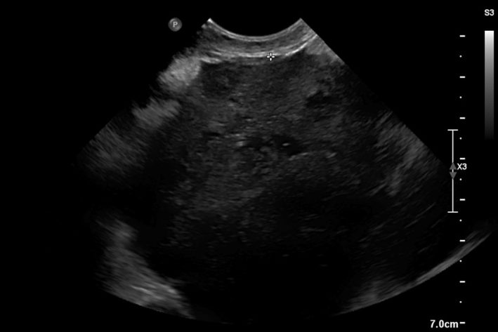 Darstellung eines Milztumors im Ultraschall