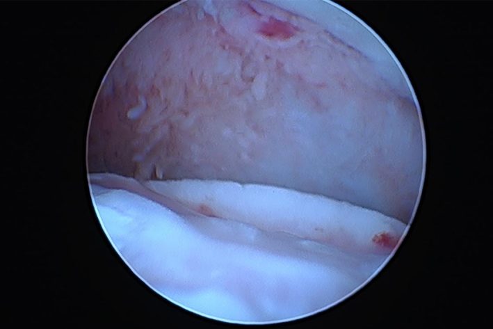 Die Schuppe wurde entfernt. OCD Bett in Abheilung