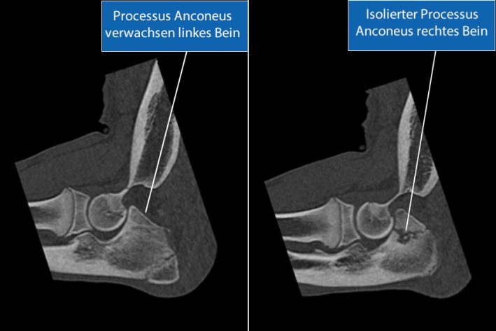 Ellbogendysplasie mit hochgradiger Inkongruenz beidseits