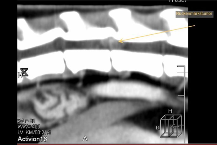 Rückenmarkstumor (Meningeom)