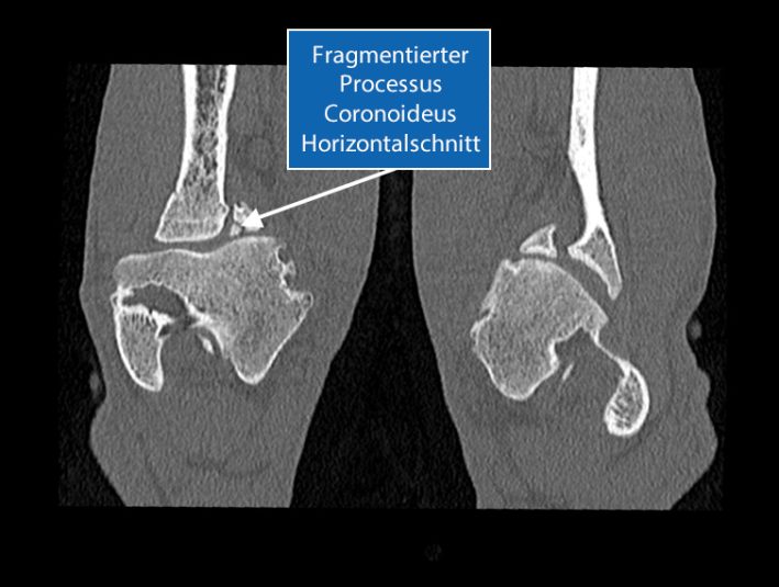 Fragmentierung des Processus Coronoideus