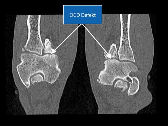 SLT Horizontalschnitt Ellbogen OCD Defektion An Beiden Medialen Condylen Des Humeru Deutliche Sklerose Am Medialen Condylus Humeri