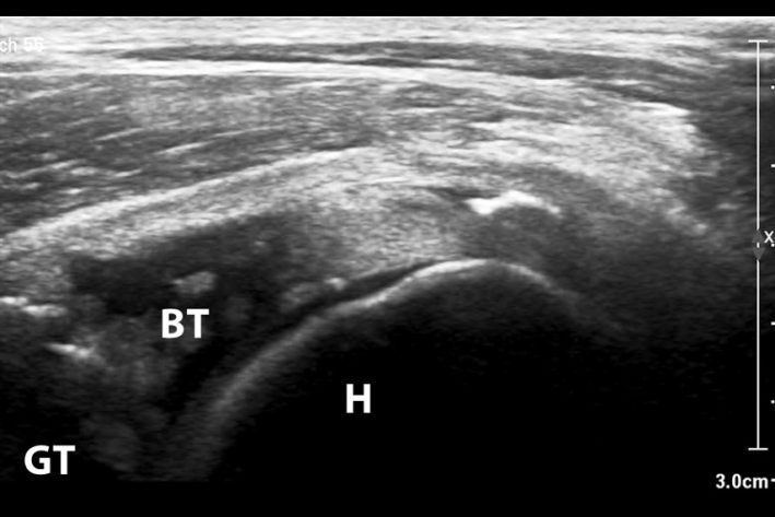 Teilruptur einer Bizepssehne