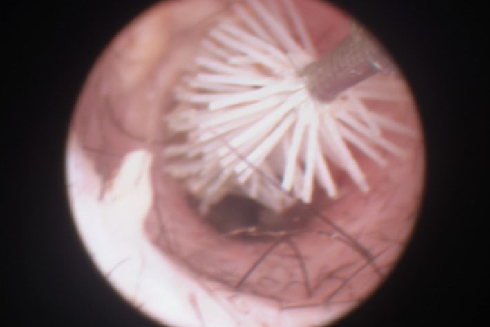 Zur effektiven Reinigung wird die endoskopische Bürste eingesetzt.