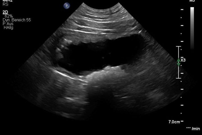 Zystitis Ultraschall