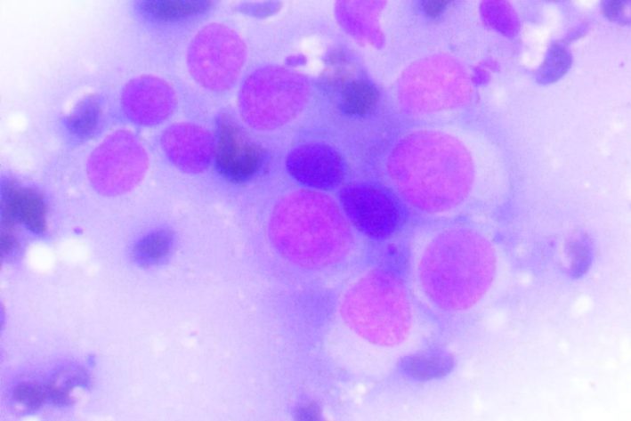 Zytologie Histiozytom