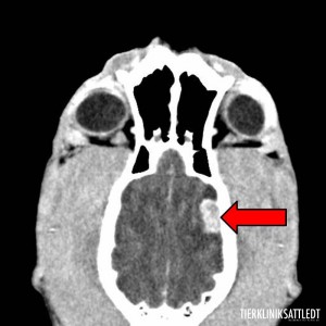 Computertomografisches Bilder eines Gehirntumores in zwei Ebenen 