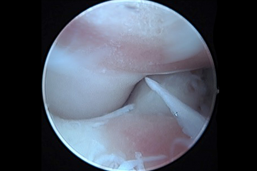 Medial Compartment Syndrom