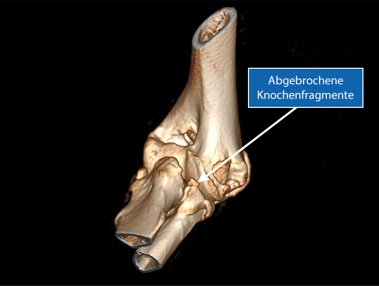 3D Rekonstruktion Ellbogen - Ellbogenarthrosen, FCP