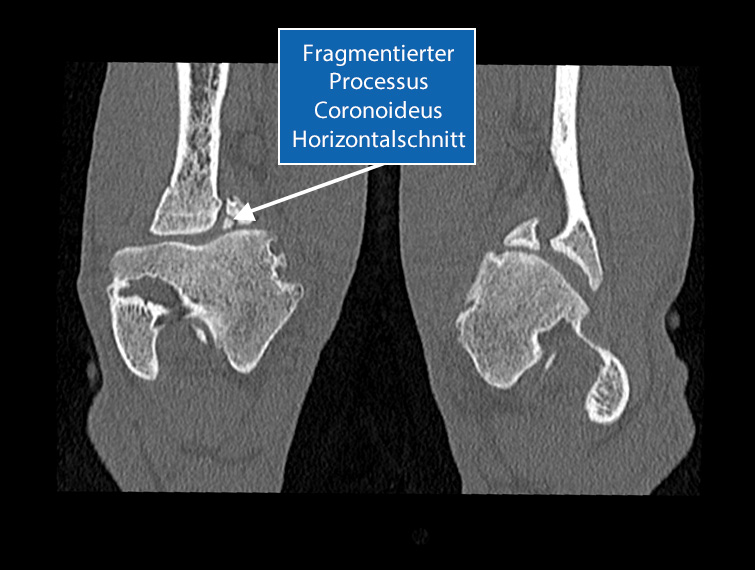 Horizontalschnitt Ellbogen - FCP am linken medialen Processus coronoideus