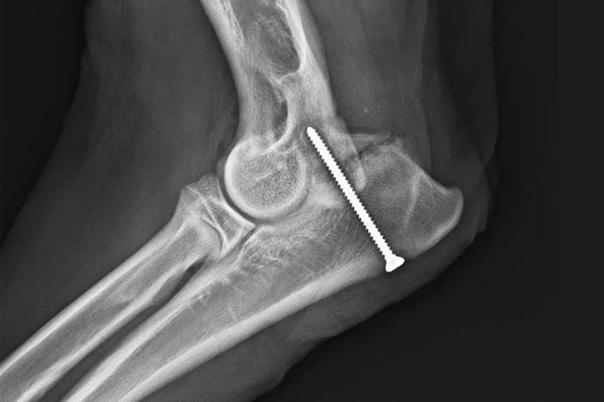 Proc. Anconeus mit Schraube